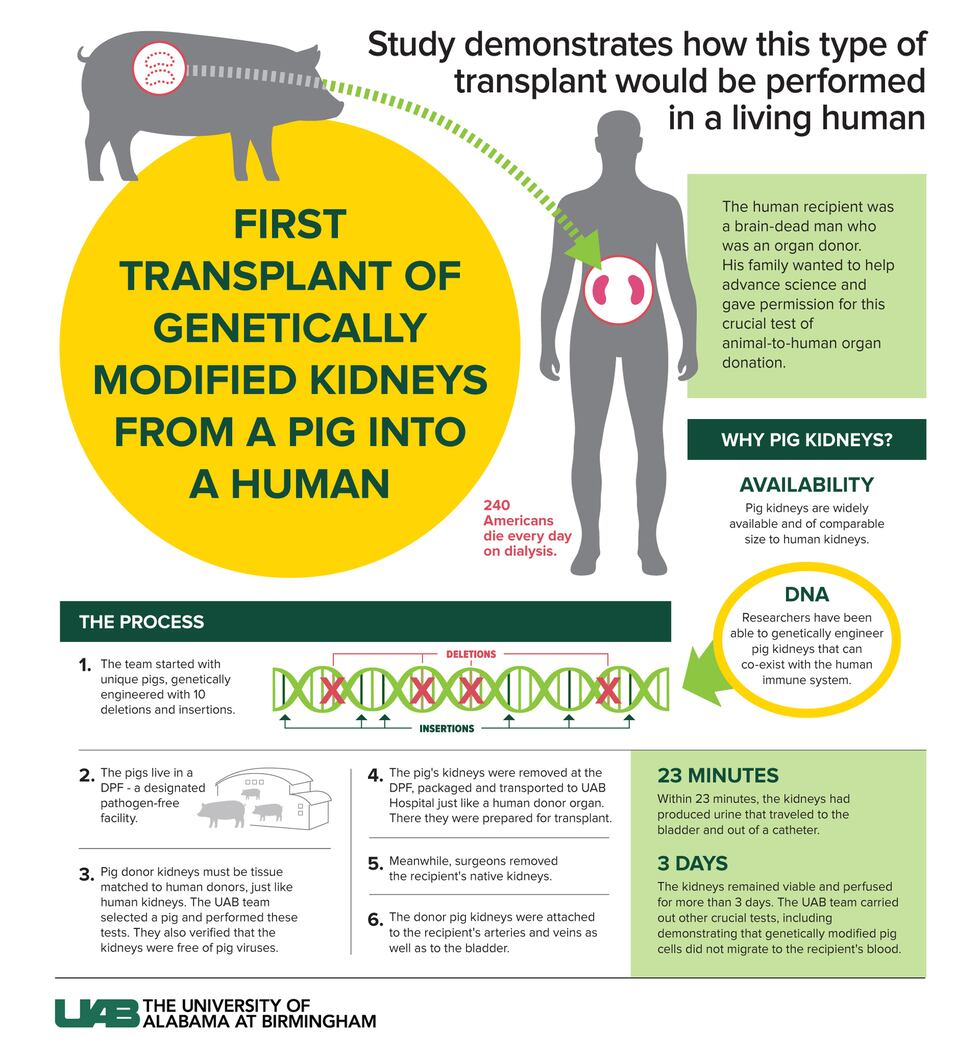 UAB announces first transplant of genetically altered pig kidney in human